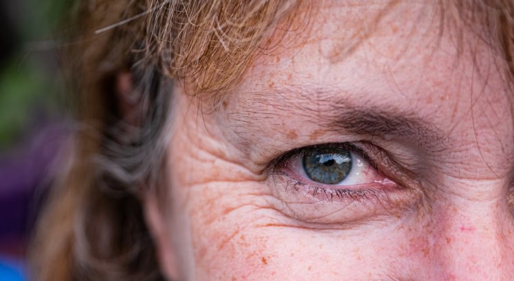 ¿Qué son las manchas oscuras en la piel?