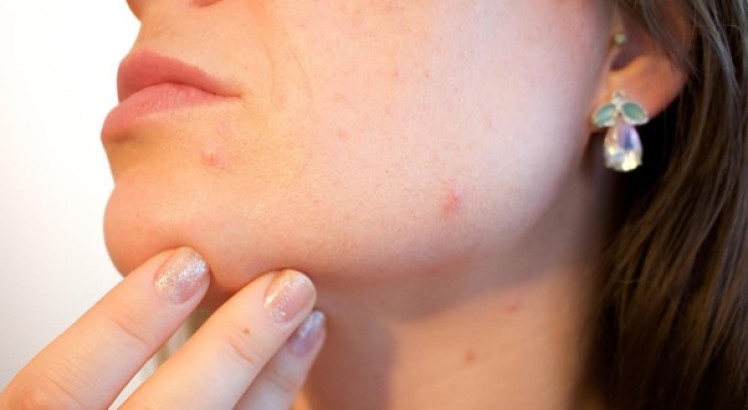Cómo tratar un brote de acné repentino en la cara
