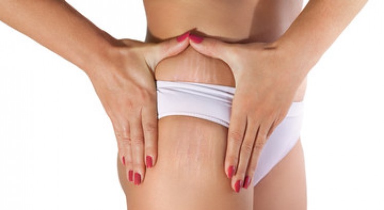 Cómo eliminar las estrías blancas: consejos