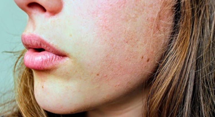 ¿Cómo tratar la piel seca con acné?