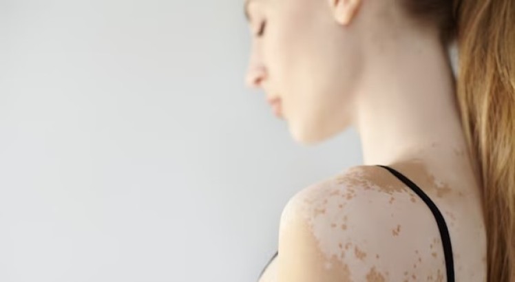 Piel con vitiligo ¿Qué cremas son recomendadas?