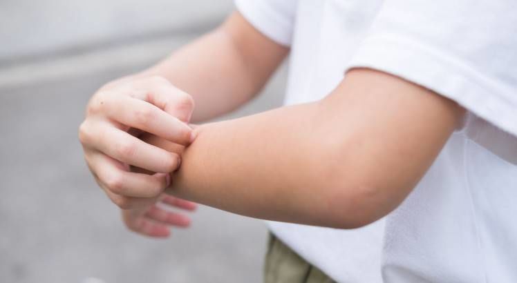 Piel atópica: qué es, causas, síntomas y consejos