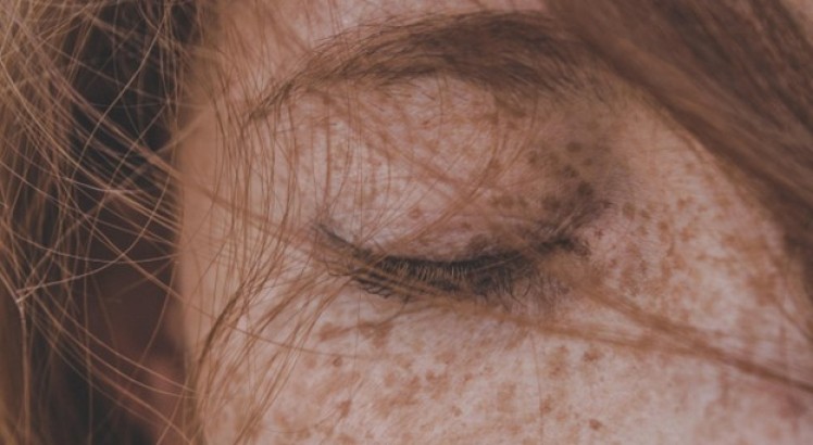 Pecas: ¿Qué significado tienen en tu piel?