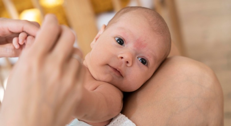 Manchas rojas en la cara de un bebé, ¿A qué se deben?