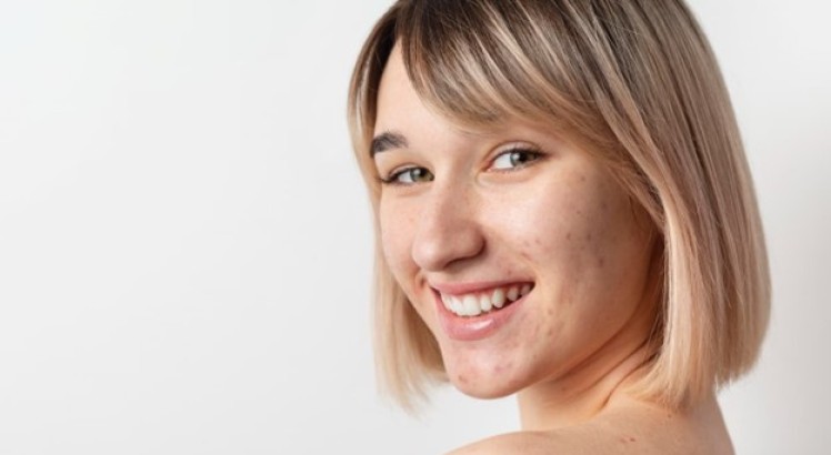 ¿Qué tipos de acné existen?