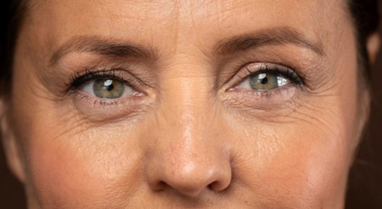 Arrugas debajo de los ojos: Causas y tratamiento