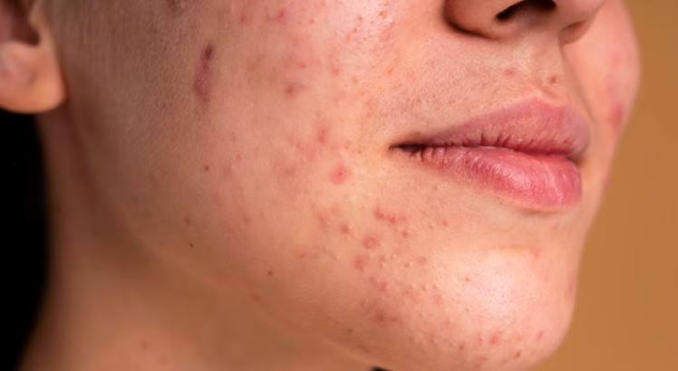 Granos en la barbilla: ¿cómo tratarlos?