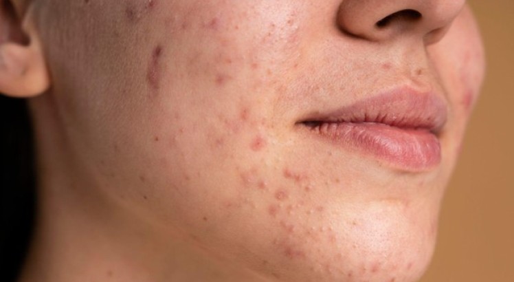 Acné adulto: ¿tiene solución?