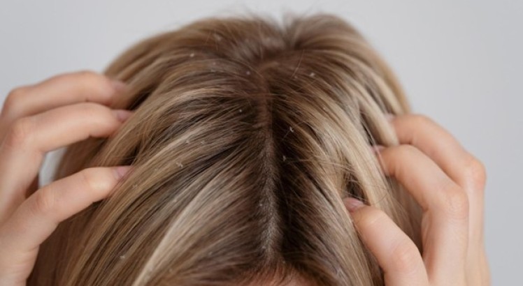 Cómo deshacerte de la caspa de manera eficaz y duradera