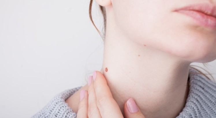 Por qué salen verrugas en el cuello