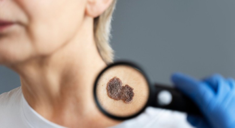 Queratosis seborreica: qué es y cuáles son sus causas