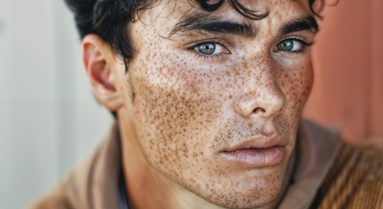 Manchas en la cara en hombres: causas y cómo prevenirlas