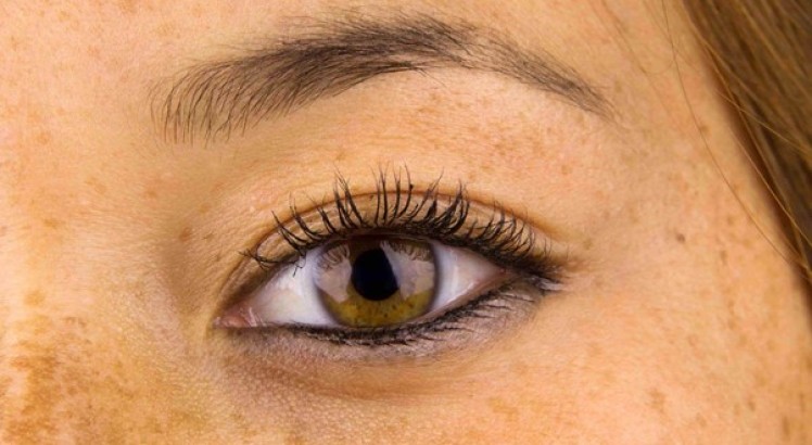 Léntigos solares: ¿Qué son y por qué aparecen?