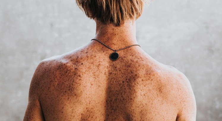 No todos los lunares son bonitos