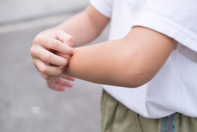 Piel atópica: qué es, causas, síntomas y consejos