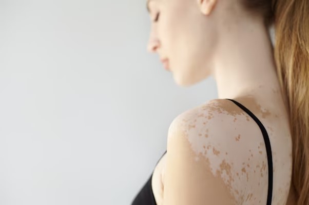 Piel con vitiligo ¿Qué cremas son recomendadas?