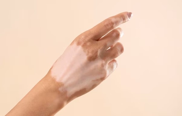 Piel con vitiligo ¿Qué cremas son recomendadas?