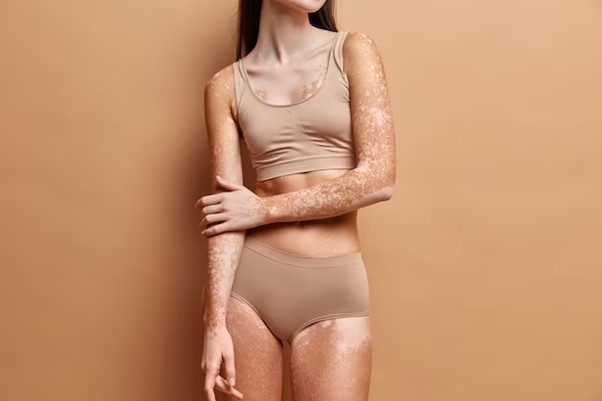 Piel con vitiligo ¿Qué cremas son recomendadas?