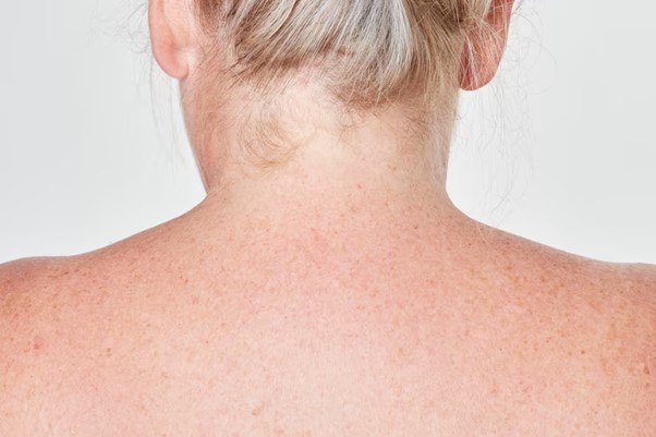 Manchas en el cuello: ¿Por qué aparecen?