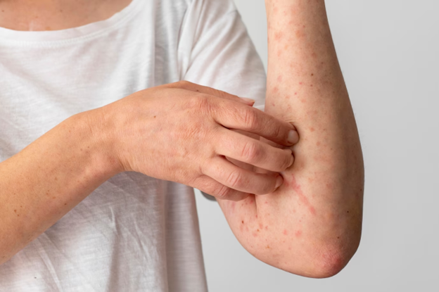 Dermatitis en el párpado: Tips para tratarlos