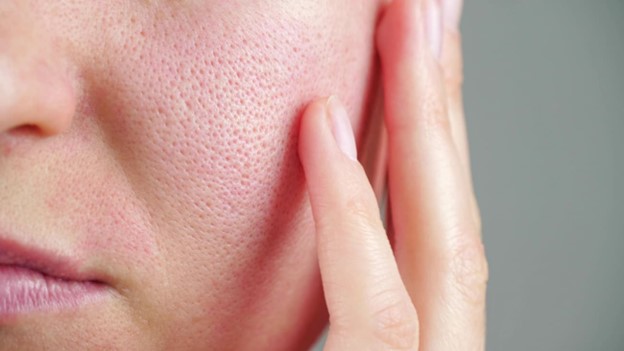 ¿Se puede utilizar retinol para piel grasa?
