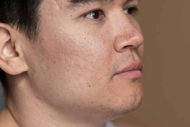 Manchas en la cara en hombres: causas y cómo prevenirlas