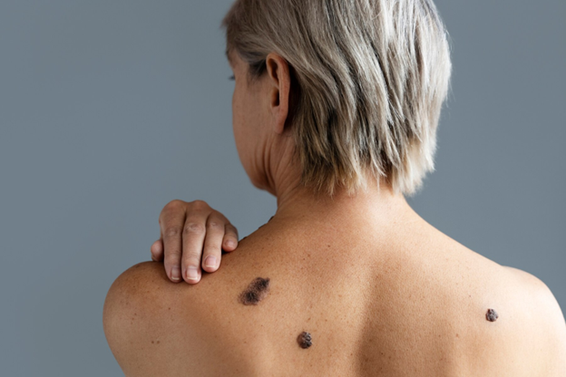 Queratosis seborreica: qué es y cuáles son sus causas