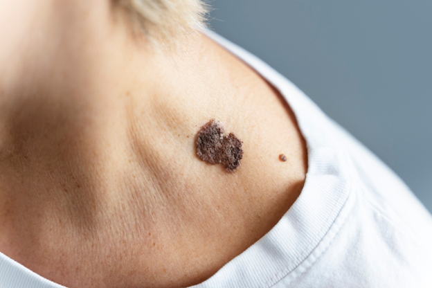 Queratosis seborreica: qué es y cuáles son sus causas